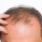 Hair Loss